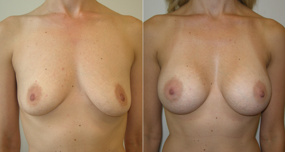 Breast Augmentation Before & After Photo