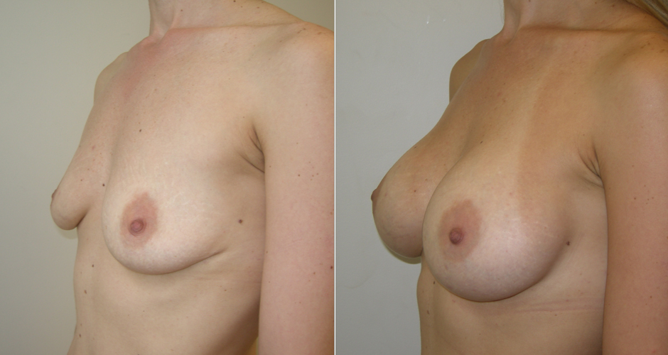 Breast Augmentation Before & After Photo