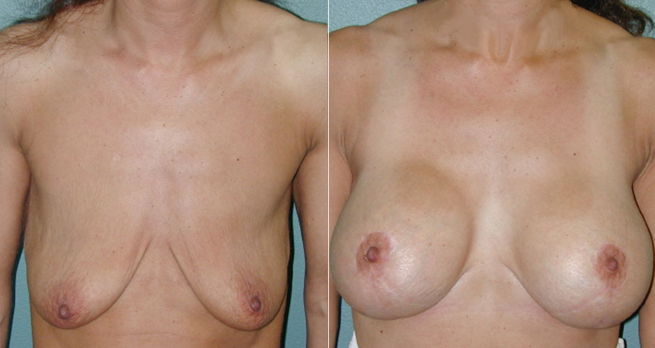 Breast Lift Before & After Photo