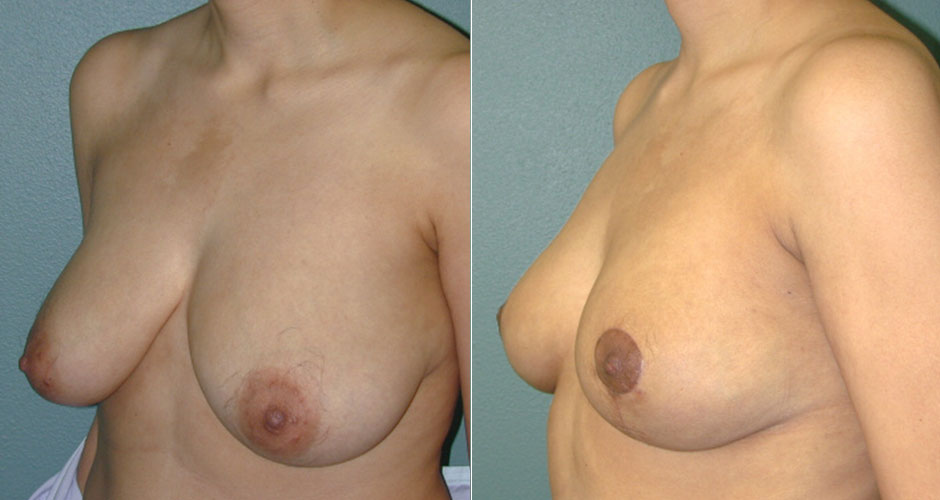 Breast Lift Before & After Photo