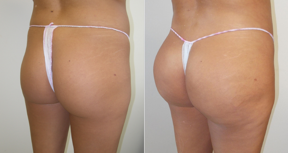 Brazilian Butt Lift Before and After Photos