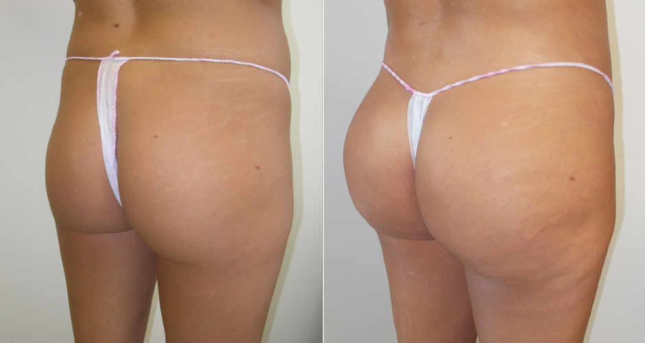 Brazilian Butt Lift: Preparation, Procedure, Recovery, Risks & More