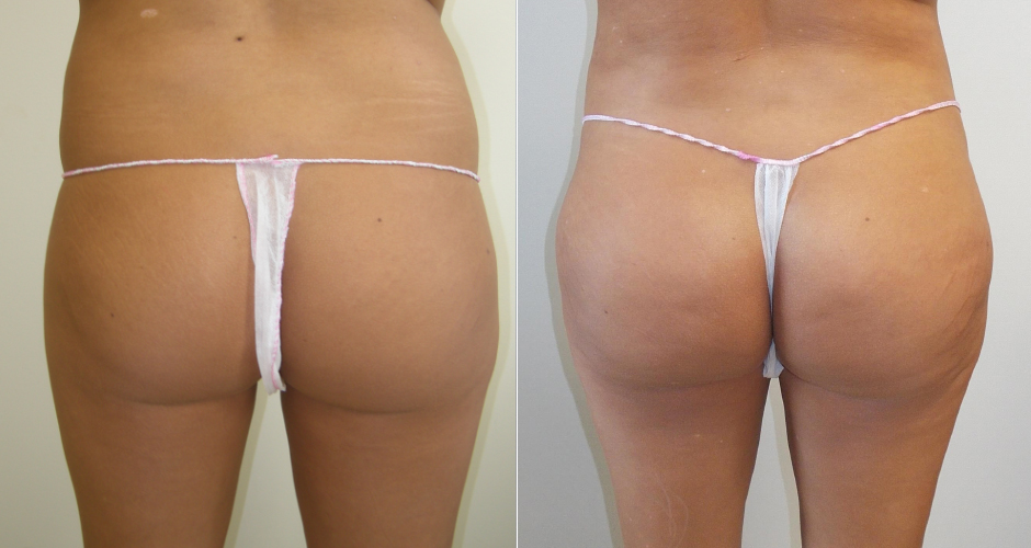 Brazilian Butt Lift Before and After Photos