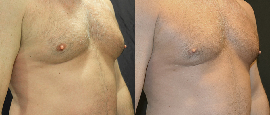 CoolSculpting for Men Before & After Photo