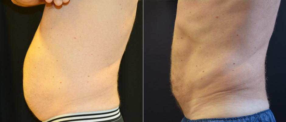 CoolSculpting for Men Before & After Photo