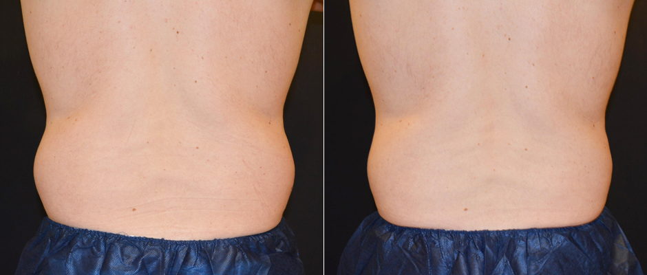 CoolSculpting for Men Before & After Photo