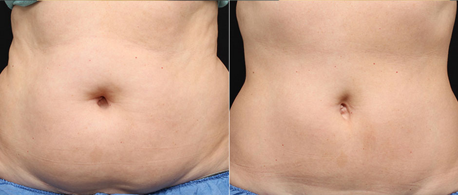 CoolSculpting for Women Before & After Photo