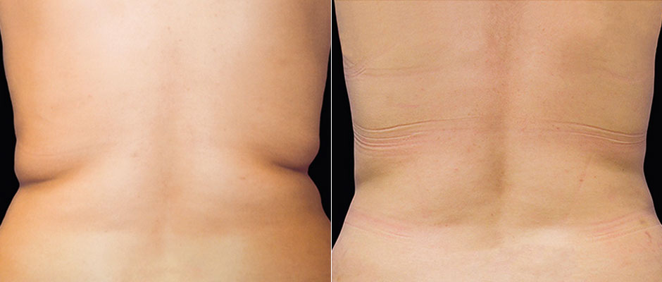 CoolSculpting for Women Before & After Photo