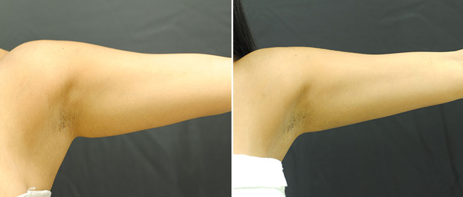 CoolSculpting for Women Before & After Photo