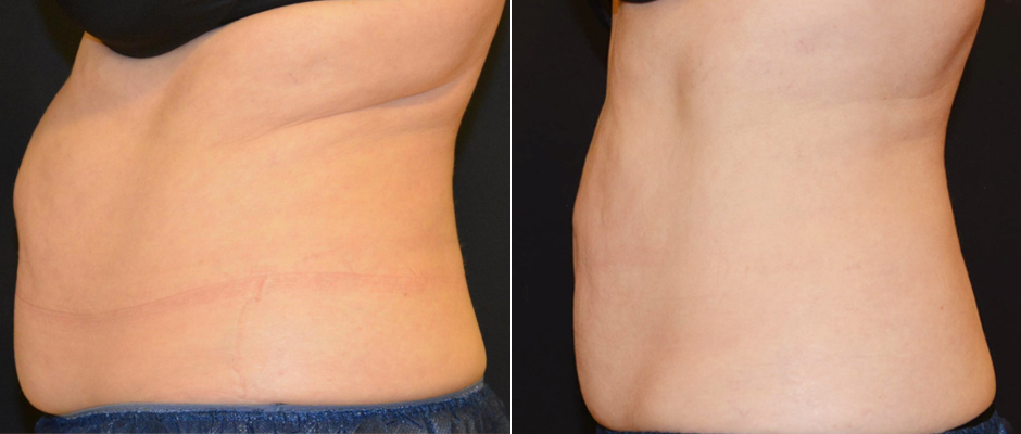 CoolSculpting for Women Before & After Photo