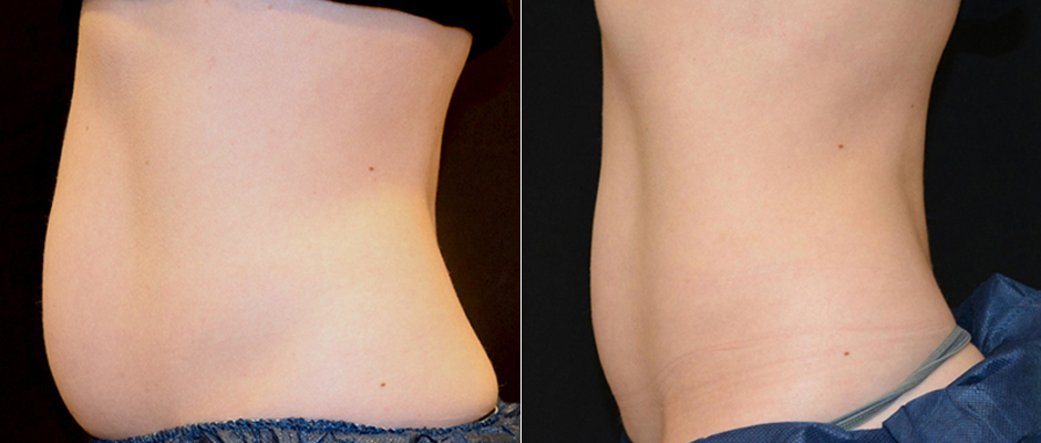 CoolSculpting for Women Before & After Photo