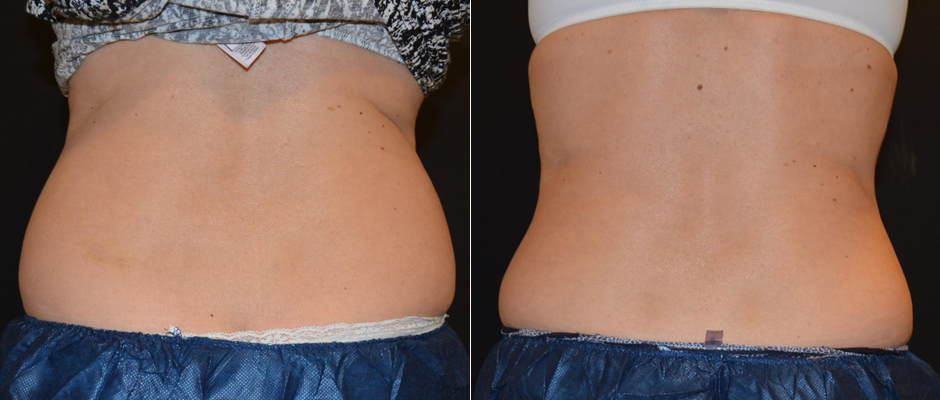 CoolSculpting for Women Before & After Photo