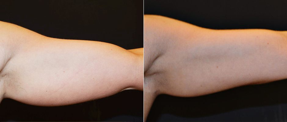 CoolSculpting for Women Before & After Photo