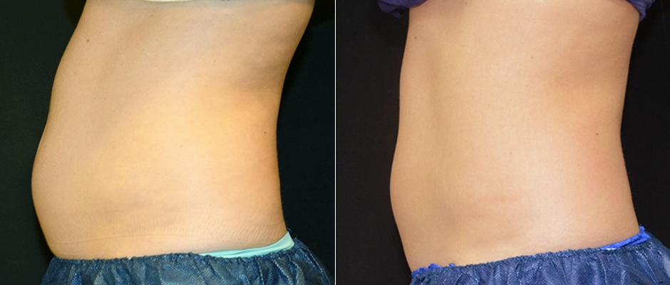 CoolSculpting for Women Before & After Photo