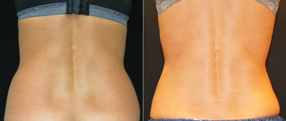 CoolSculpting for Women Before & After Photo