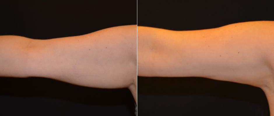 CoolSculpting for Women Before & After Photo