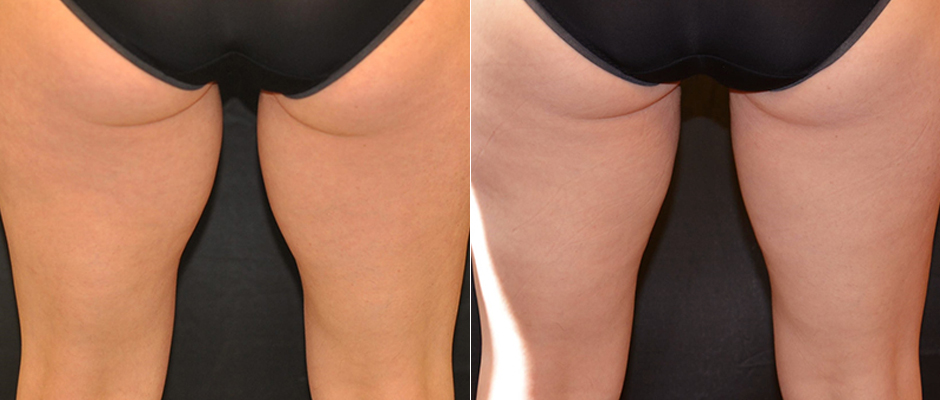 CoolSculpting for Women Before & After Photo