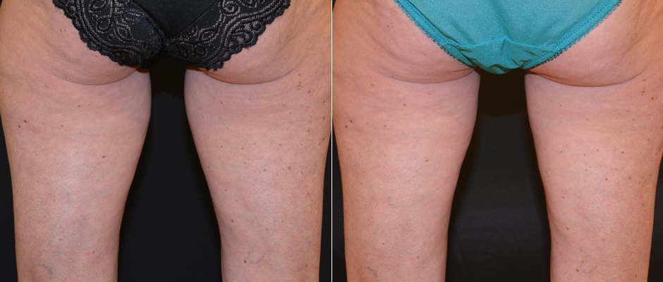 CoolSculpting for Women Before & After Photo