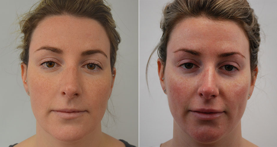 Face & Lip Fillers in Toronto The Plastic Surgery Clinic Face & Lip Fillers in Toronto The Plastic Surgery Clinic