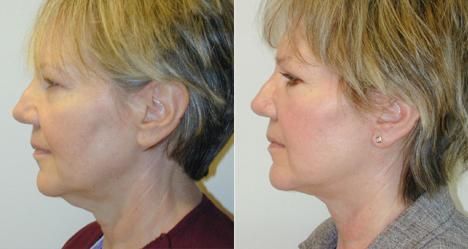 Face Lift Before & After Photo