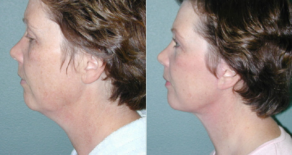 Face Lift Before & After Photo