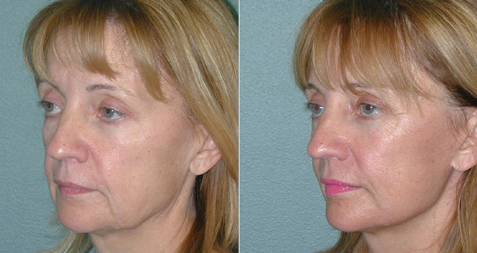 Face Lift Before & After Photo