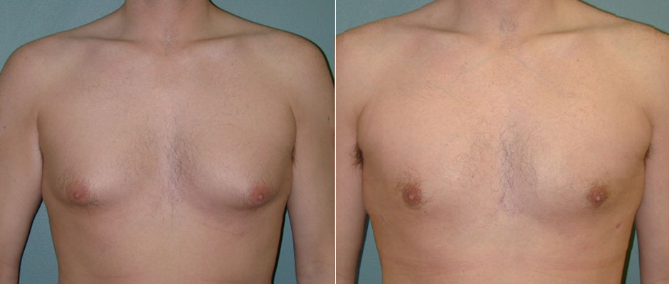 Gynecomastia Before & After Photo