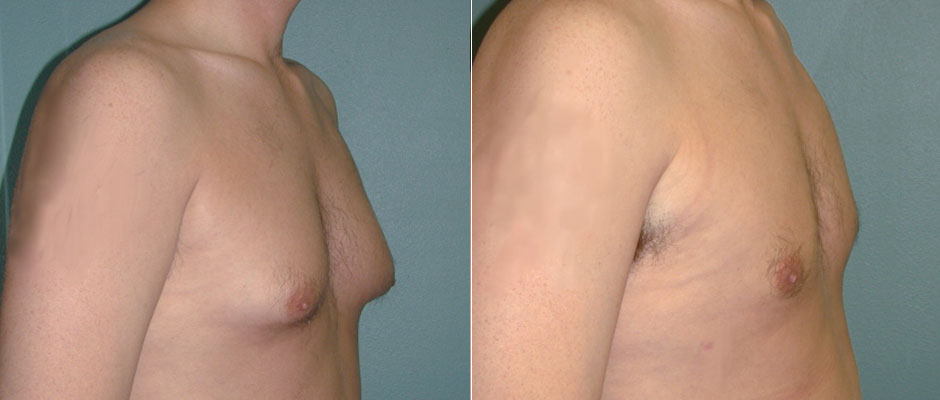 Gynecomastia Surgery aka Male Breast Reduction: What To Know