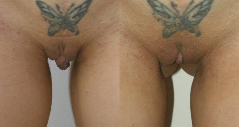 Labiaplasty Before & After Photo