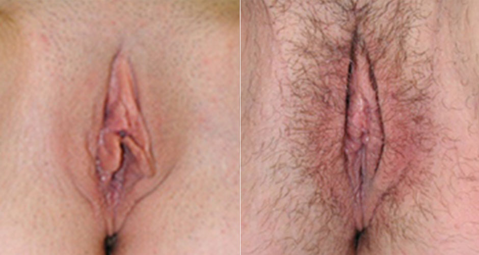 Labiaplasty Before & After Photo