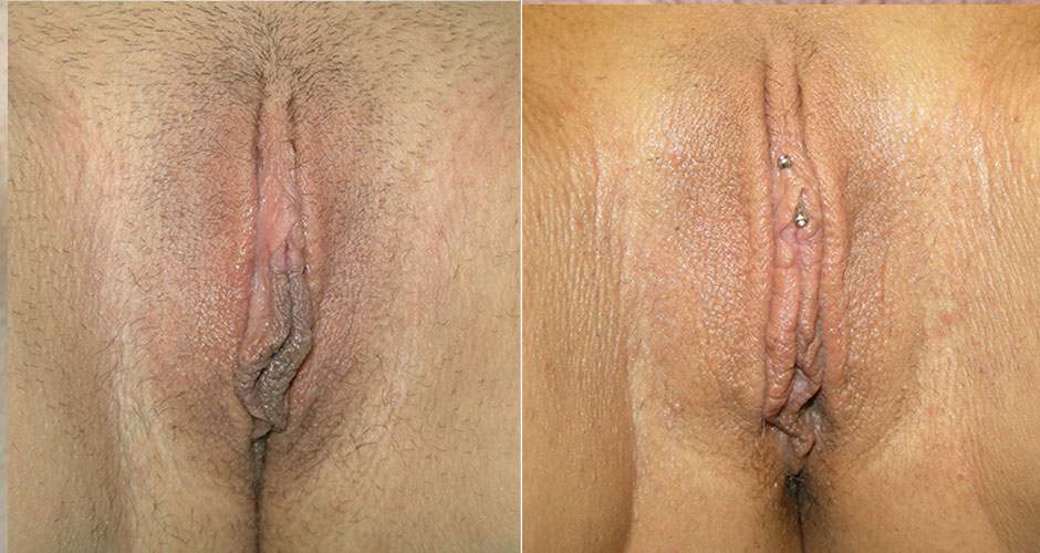 Labiaplasty Before & After Photo