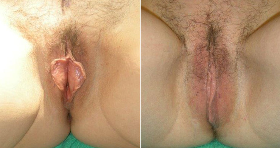 Labiaplasty Before & After Photo