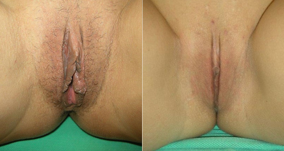 Labiaplasty Before & After Photo