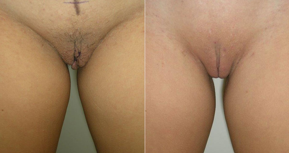 Labiaplasty Before & After Photo