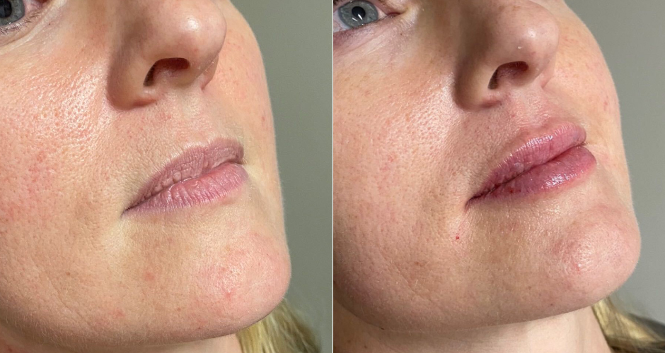 Lip Filler Before and After Photo