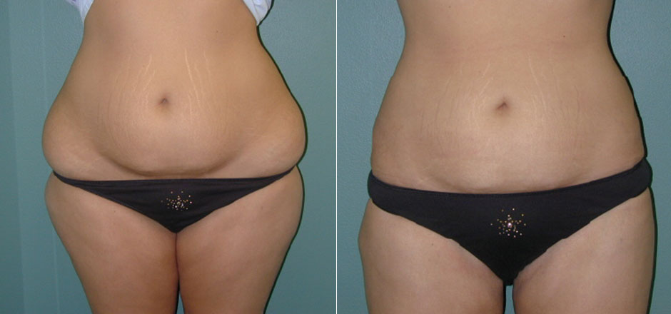 Liposuction Before & After Photo