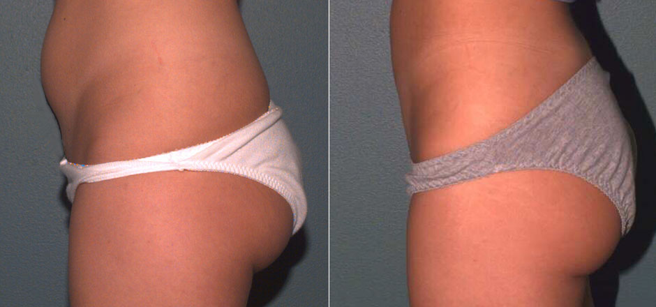 Liposuction Before & After Photo