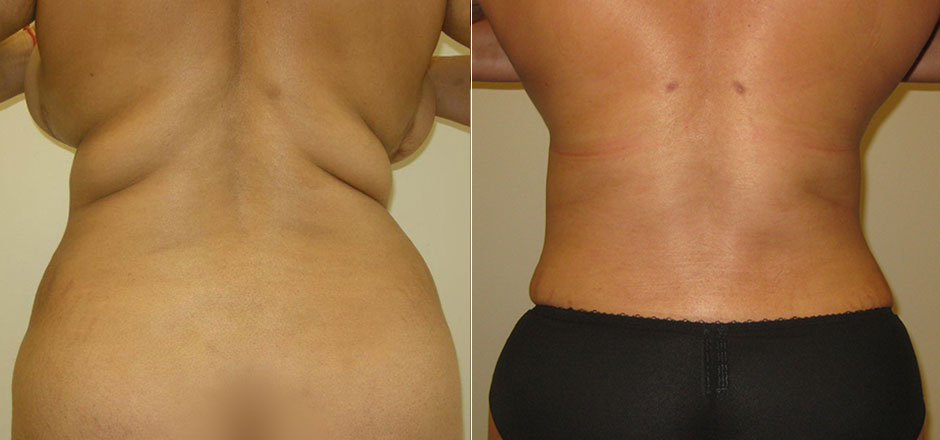 Liposuction Before & After Photo