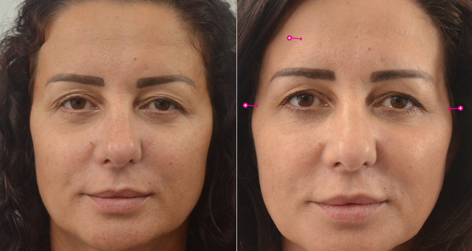 Injections for Wrinkles Before & After Photo