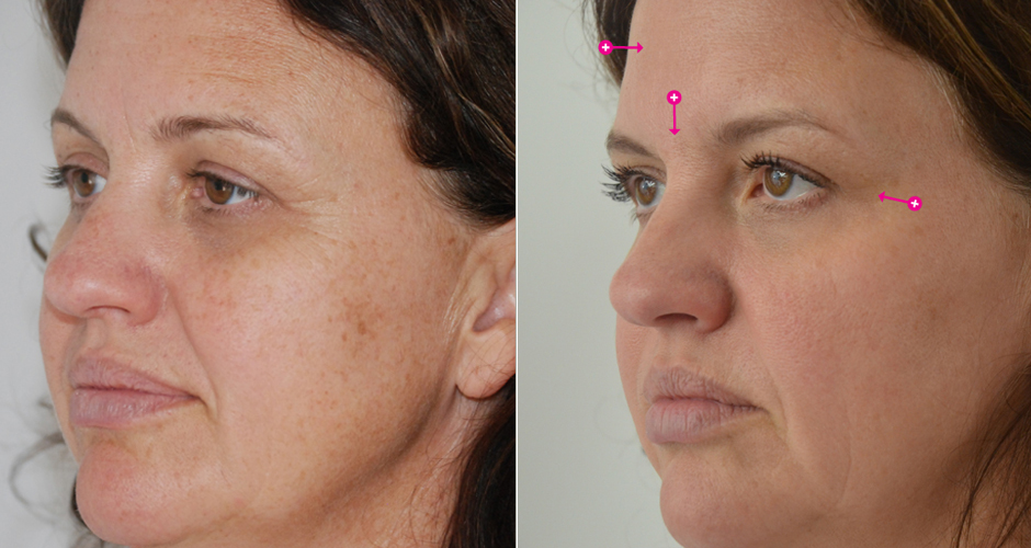 Injections for Wrinkles Before & After Photo