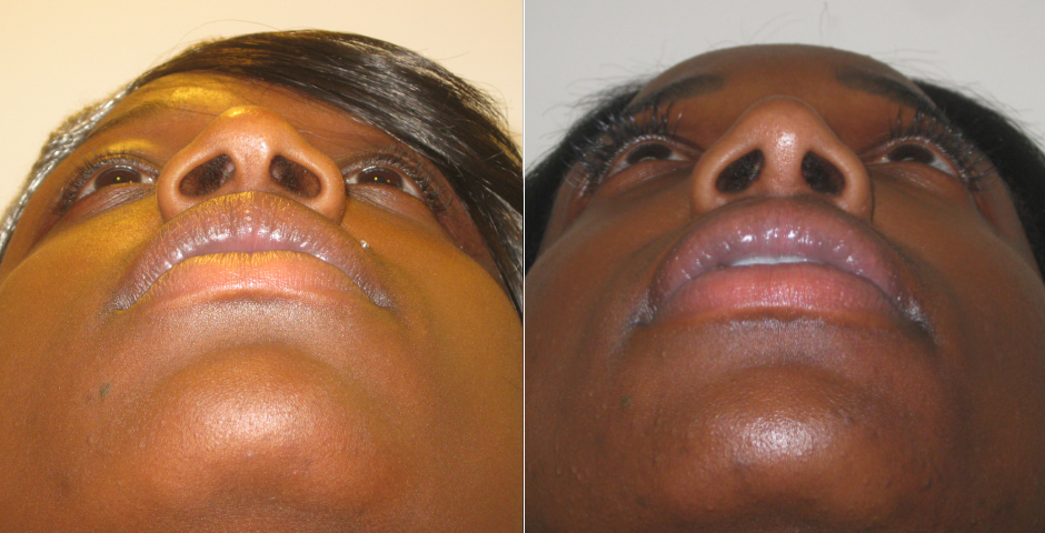 Rhinoplasty Before and After Photos