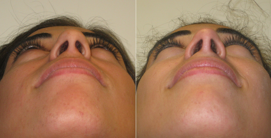 Rhinoplasty Before and After Photos