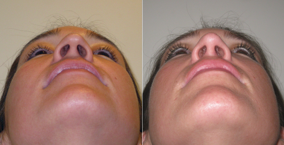 Rhinoplasty Before and After Photos