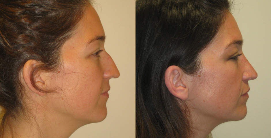 Rhinoplasty Before and After Photos