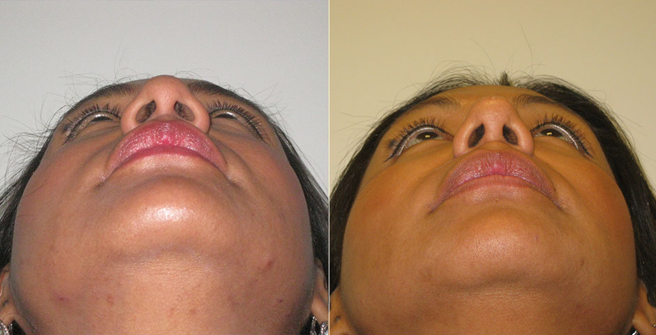 Rhinoplasty Before & After Photo