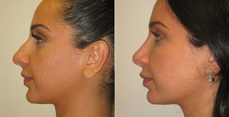 Rhinoplasty Before & After Photo