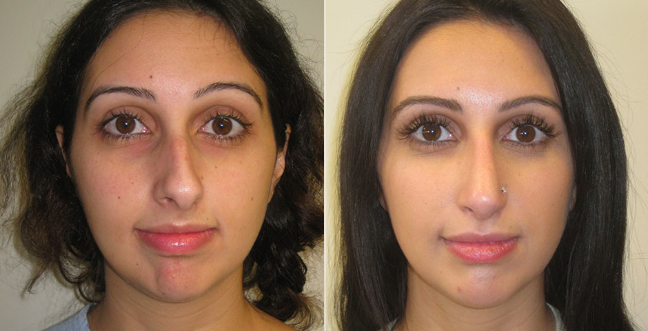 Rhinoplasty Before & After Photo