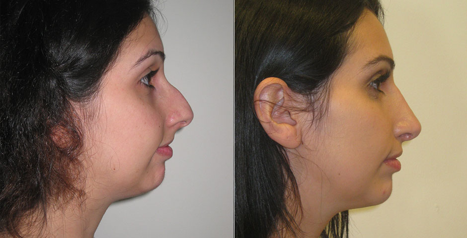 Rhinoplasty Before & After Photo