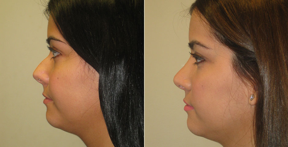 Rhinoplasty Before & After Photo