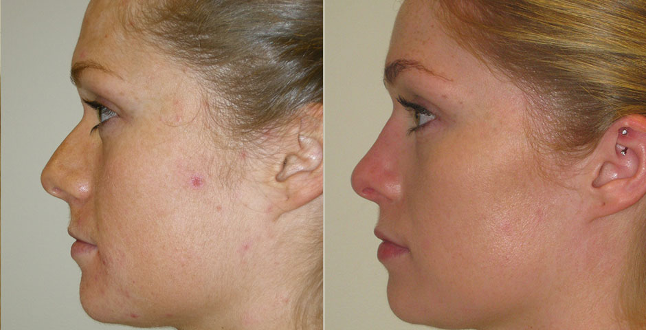 Rhinoplasty Before & After Photo